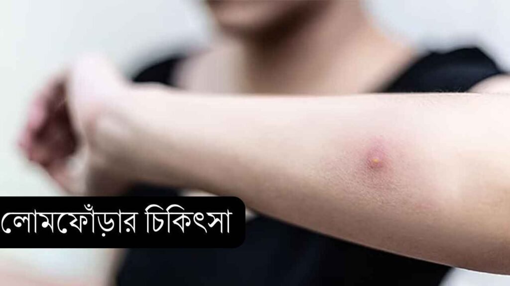 লোমফোঁড়ার চিকিৎসা